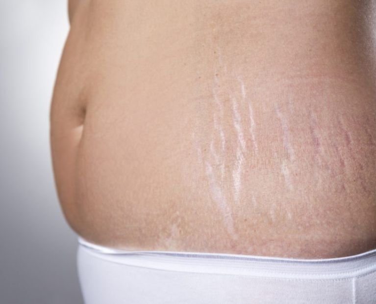 stretch mark & saggy skin treatment