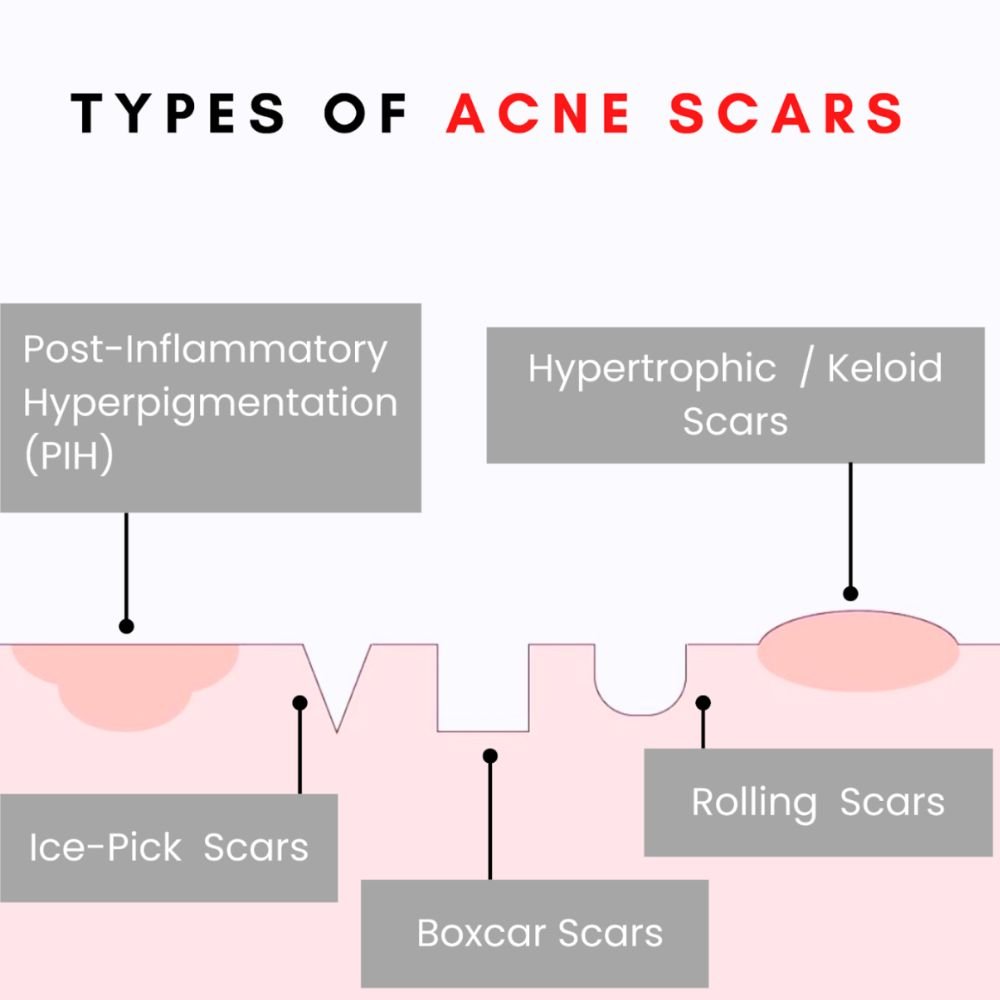 types of acne Scar