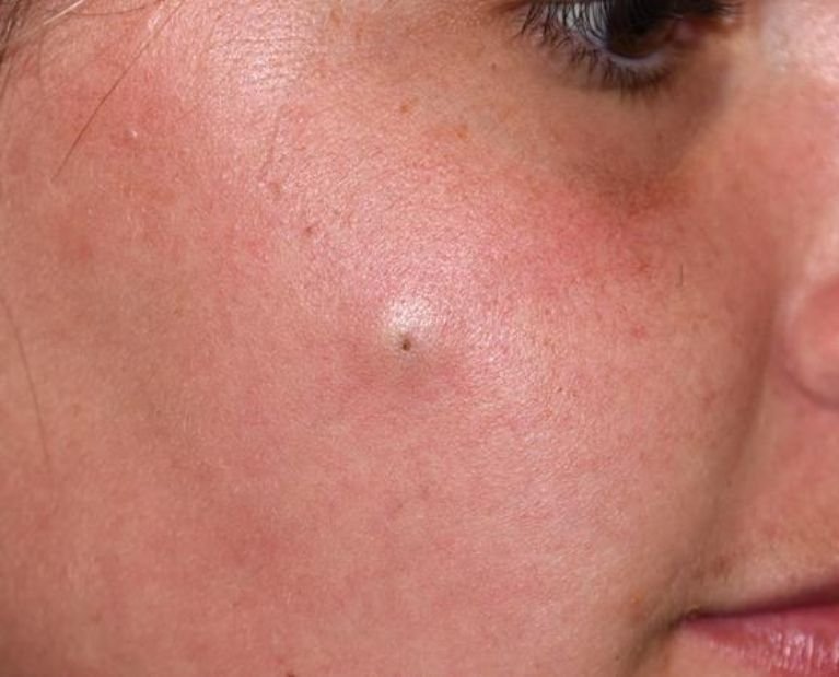 Laser Skin Treatments - acne treatment malaysia