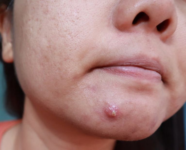 Pustule - acne treatment malaysia