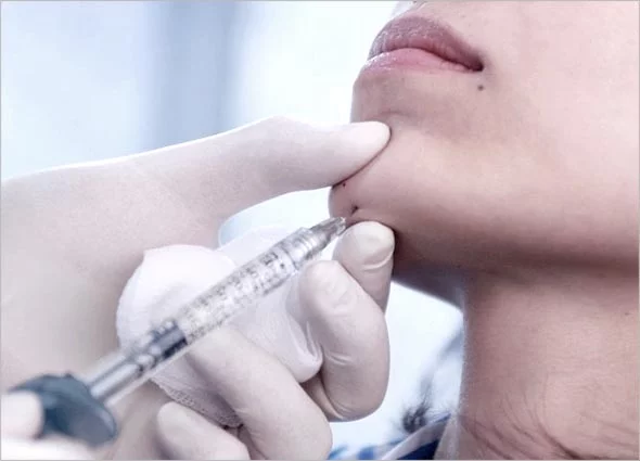 dermal filler for instant volume and contouring