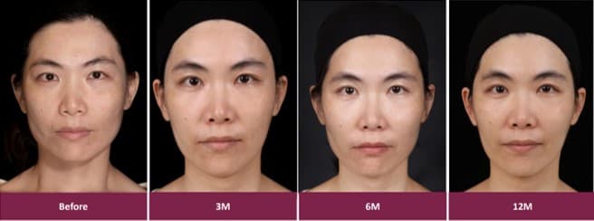 sculptra side effects