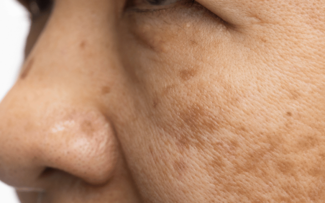 pigmentation treatment